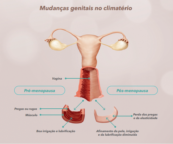 Ilustração sistema reprodutor feminino mostrando a atrofia vaginal na sexualidade. 
