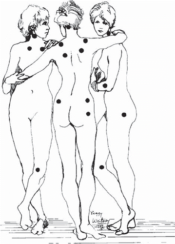 Ilustração de três mulheres e marcações nos locais das dores de fibromialgia. 