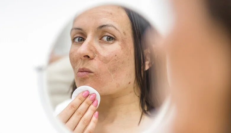 Como prevenir o melasma?