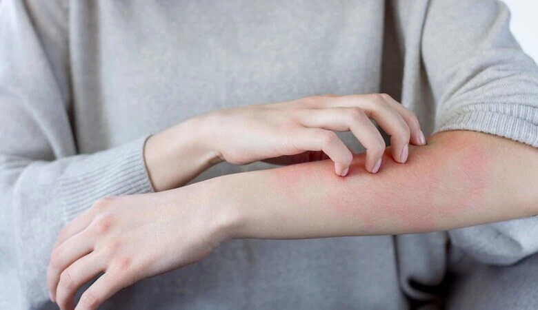 Como escolher o sabonete adequado para dermatite atópica?
