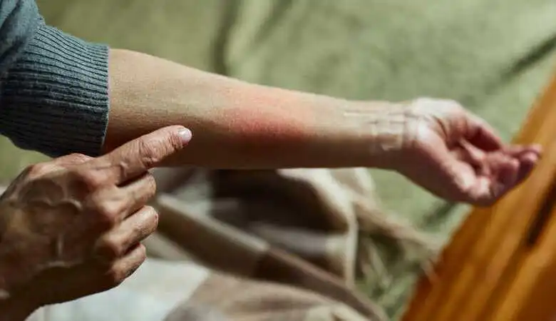 Descubra quais os tipos de eczema e aprenda a diferenciá-los