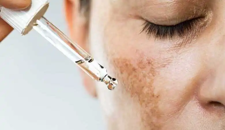 Melasma: O que é, quais os tipos e como tratar?