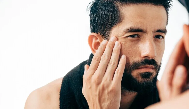Melasma em homens: guia sobre causas, sintomas e tratamentos