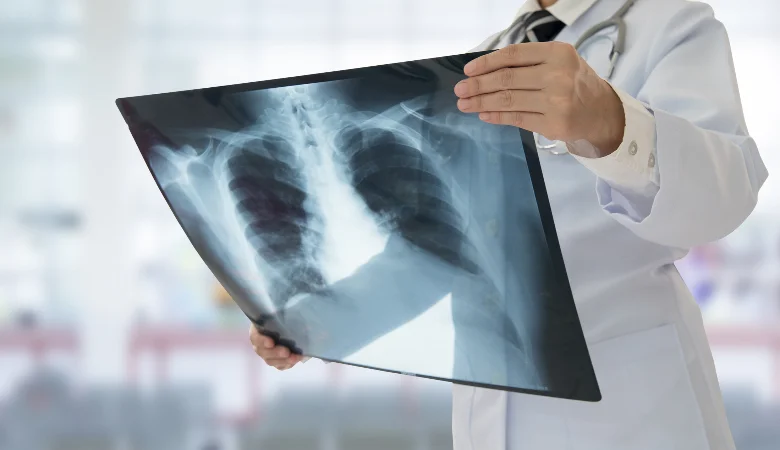 Síndrome respiratória aguda grave (SRAG) tem aumentado: veja como se prevenir