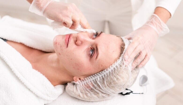 Combatendo a acne: guia para uma rotina de cuidados com a pele
