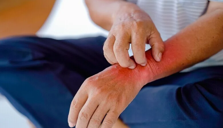 Qual a relação entre estresse e a dermatite atópica? Descubra agora!