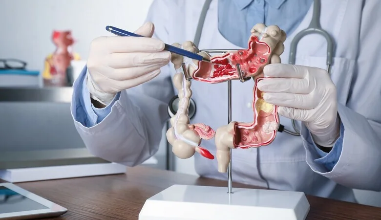 Lúpus e problemas intestinais