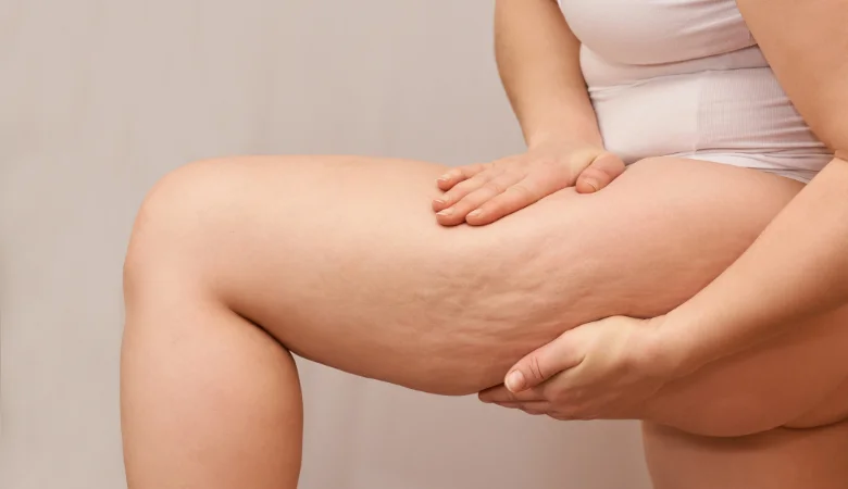 Lipedema: entenda esse diagnóstico e tratamentos!
