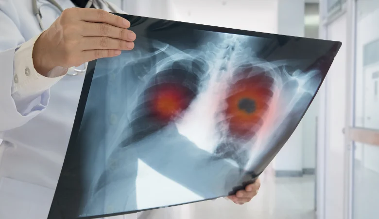 Enfisema pulmonar é coisa séria: veja tratamentos e como prevenir!