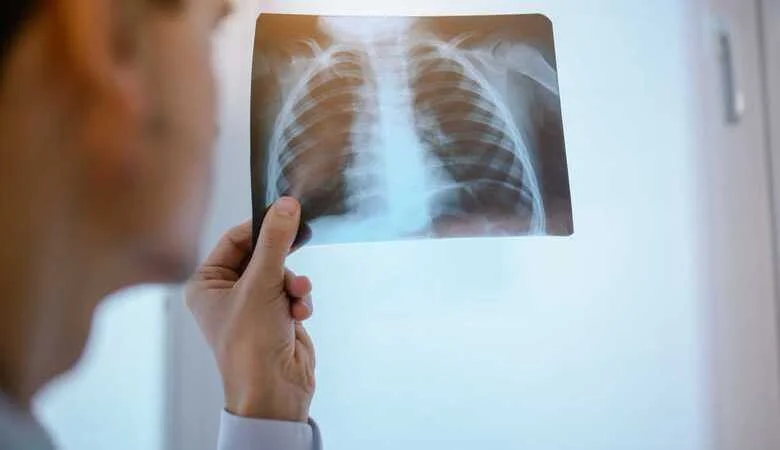 SDRA: conheça a síndrome do desconforto respiratório agudo!