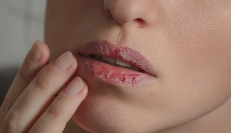 Efeitos colaterais no tratamento da acne: como lidar com eles?