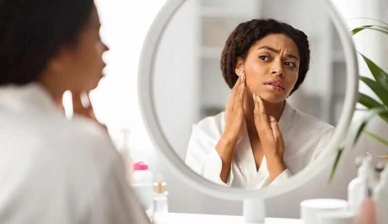 Efeitos colaterais no tratamento da acne: como lidar com eles?