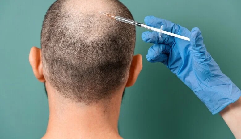 Alopecia androgenética: conheça a calvície masculina!