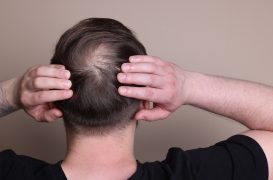 Remédios para queda de cabelo disfunção erétil sexual