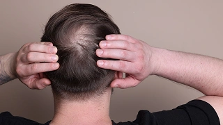 Mitos e verdades: remédios para queda de cabelo causam mesmo disfunção sexual?