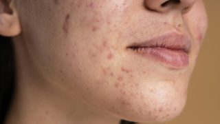 close-up do rosto de uma mulher jovem branca, ressaltando a pele com acne