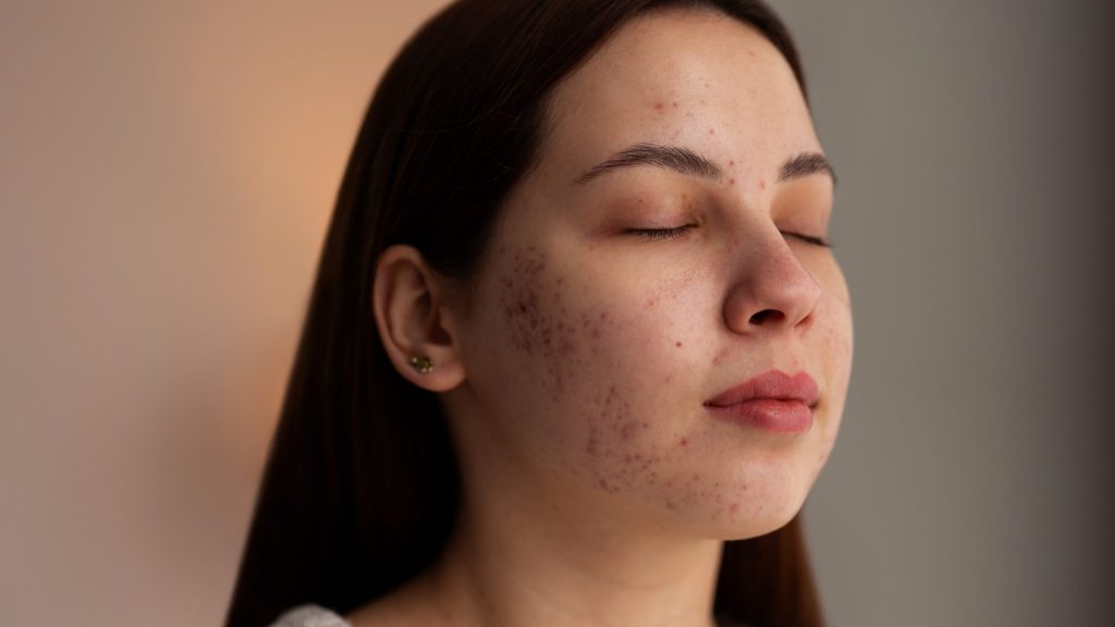 close-up de mulher jovem de olhos fechados com acne nas bochechas e na testa
